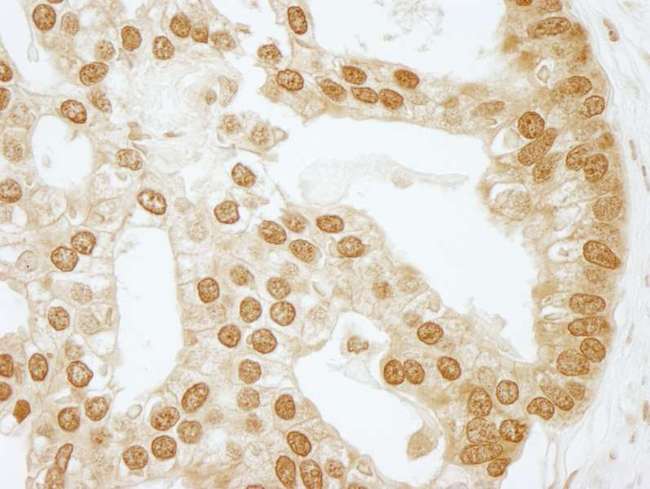 CSNK2B / Phosvitin Antibody - Detection of Human CKII-beta by Immunohistochemistry. Sample: FFPE section of human prostate carcinoma. Antibody: Affinity purified rabbit anti-CKII beta used at a dilution of 1:250. Epitope Retrieval Buffer-High pH (IHC-101J) was substituted for Epitope Retrieval Buffer-Reduced pH.