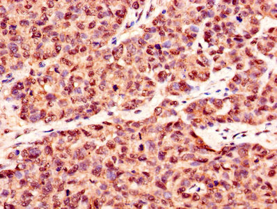 CSNK2B / Phosvitin Antibody - Immunohistochemistry of paraffin-embedded human ovarian cancer using CSNK2B Antibody at dilution of 1:100