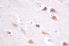 CSNK2B / Phosvitin Antibody - IHC of CK2- (S205) pAb in paraffin-embedded human breast tissue.