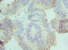 CSRNP1 / AXUD1 Antibody - Immunohistochemistry of paraffin-embedded human colon cancer using antibody at 1:100 dilution.
