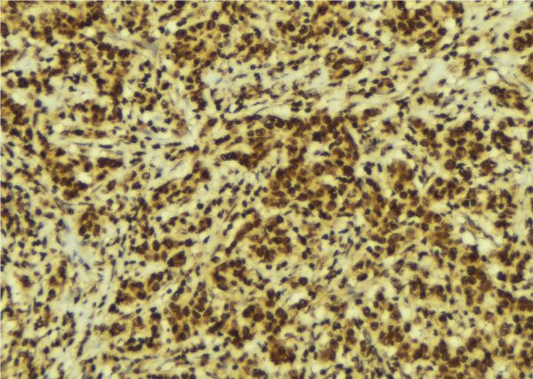 CSRP1 Antibody - 1:100 staining human breast carcinoma tissue by IHC-P. The sample was formaldehyde fixed and a heat mediated antigen retrieval step in citrate buffer was performed. The sample was then blocked and incubated with the antibody for 1.5 hours at 22°C. An HRP conjugated goat anti-rabbit antibody was used as the secondary.