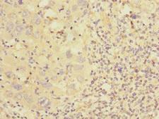 CSRP2 Antibody - Immunohistochemistry of paraffin-embedded human liver cancer at dilution 1:100