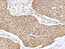 CSRP2 Antibody - Immunohistochemistry of paraffin-embedded Human esophagus cancer tissue  using CSRP2 Polyclonal Antibody at dilution of 1:70(×200)