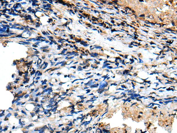 CSRP3 Antibody - Immunohistochemistry of paraffin-embedded Human lung cancer tissue  using CSRP3 Polyclonal Antibody at dilution of 1:40(×200)