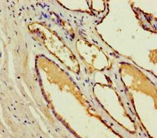 CST11 Antibody - Immunohistochemistry of paraffin-embedded human prostate cancer using CST11 Antibody at dilution of 1:100