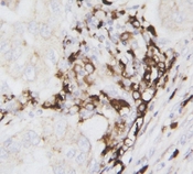 CST3 / Cystatin C Antibody - IHC-P: Cystatin C antibody testing of human breast cancer tissue