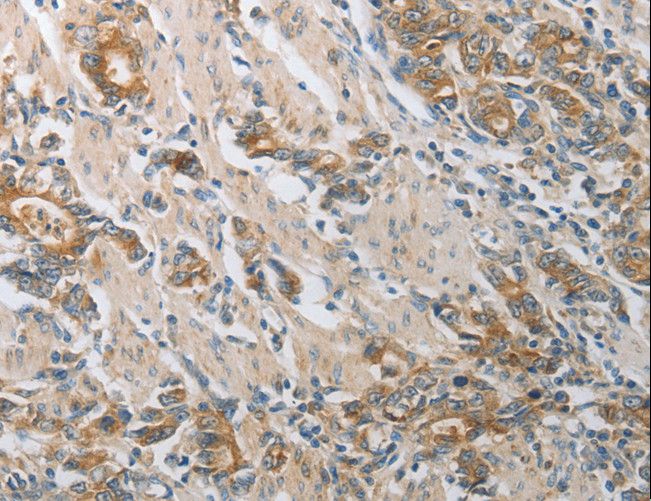CST3 / Cystatin C Antibody - Immunohistochemistry of paraffin-embedded Human gastric cancer using CST3 Polyclonal Antibody at dilution of 1:50.