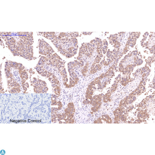 CST3 / Cystatin C Antibody - Immunohistochemical analysis of human liver cancer tissue. Anti-Cystatin C at 1:200 (4°C, overnight). Antigen retrieval - Sodium Citrate pH6 (>98°C, 20min). Secondary - 1:200 (room temp, 30min). Negative control - Secondary only