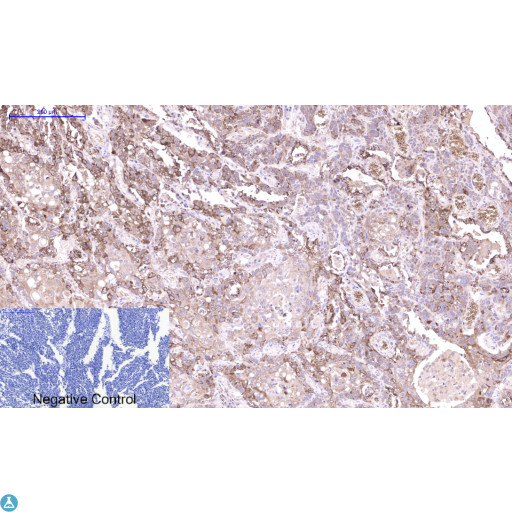 CST3 / Cystatin C Antibody - Immunohistochemical analysis of human lung cancer tissue. Anti-Cystatin C at 1:200 (4°C, overnight). Antigen retrieval - Sodium Citrate pH6 (>98°C, 20min). Secondary - 1:200 (room temp, 30min). Negative control - Secondary only
