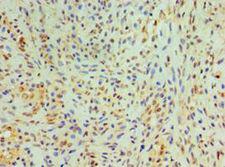 CST4 / Cystatin S Antibody - Immunohistochemistry of paraffin-embedded human breast cancer using antibody at 1:100 dilution.