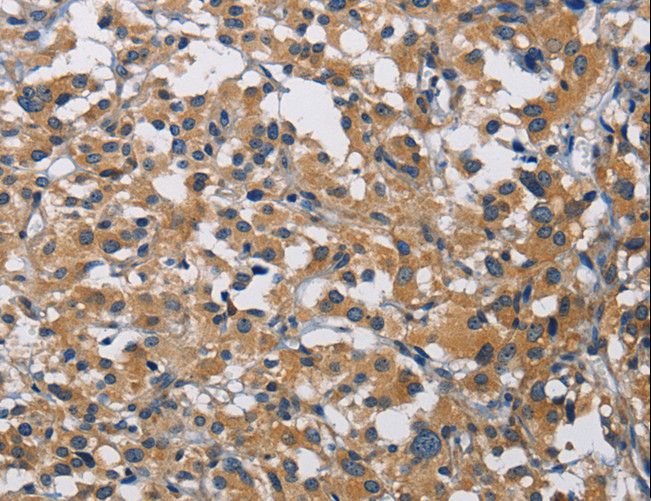 CST4 / Cystatin S Antibody - Immunohistochemistry of paraffin-embedded Human thyroid cancer using CST4 Polyclonal Antibody at dilution of 1:60.