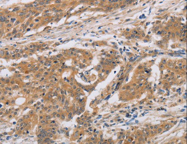 CST6 / Cystatin E/M Antibody - Immunohistochemistry of paraffin-embedded Human liver cancer using CST6 Polyclonal Antibody at dilution of 1:30.