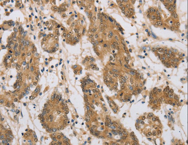 CST6 / Cystatin E/M Antibody - Immunohistochemistry of paraffin-embedded Human colon cancer using CST6 Polyclonal Antibody at dilution of 1:70.