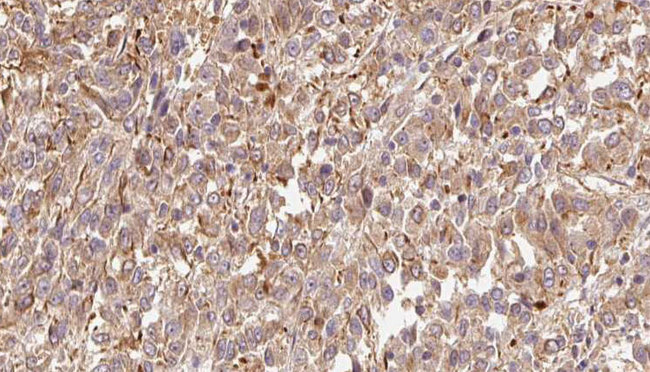 CST6 / Cystatin E/M Antibody - 1:100 staining human Melanoma tissue by IHC-P. The sample was formaldehyde fixed and a heat mediated antigen retrieval step in citrate buffer was performed. The sample was then blocked and incubated with the antibody for 1.5 hours at 22°C. An HRP conjugated goat anti-rabbit antibody was used as the secondary.