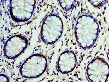 CST7 / Cystatin F Antibody - Immunohistochemistry of paraffin-embedded human colon cancer using antibody at 1:100 dilution.