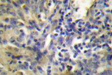CSTA / Cystatin A Antibody - IHC of Cystatin A (G84) pAb in paraffin-embedded human lung carcinoma tissue.
