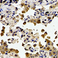 CSTA / Cystatin A Antibody - Immunohistochemical analysis of Cystatin A staining in human lung cancer formalin fixed paraffin embedded tissue section. The section was pre-treated using heat mediated antigen retrieval with sodium citrate buffer (pH 6.0). The section was then incubated with the antibody at room temperature and detected using an HRP polymer system. DAB was used as the chromogen. The section was then counterstained with hematoxylin and mounted with DPX.