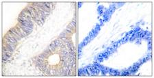 CSTA / Cystatin A Antibody - Peptide - + Immunohistochemistry analysis of paraffin-embedded human colon carcinoma tissue using Stefin A antibody.