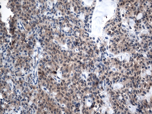 CSTB / Cystatin B / Stefin B Antibody - Immunohistochemical staining of paraffin-embedded Carcinoma of Human pancreas tissue using anti-CSTB mouse monoclonal antibody. (Heat-induced epitope retrieval by 1mM EDTA in 10mM Tris buffer. (pH8.5) at 120°C for 3 min. (1:500)