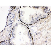 CSTB / Cystatin B / Stefin B Antibody - Stefin B antibody IHC-paraffin. IHC(P): Human Prostatic Cancer Tissue.