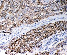 CSTB / Cystatin B / Stefin B Antibody - CSTB / Cystatin B / Stefin B antibody. IHC(P): Human Lung Cancer Tissue.