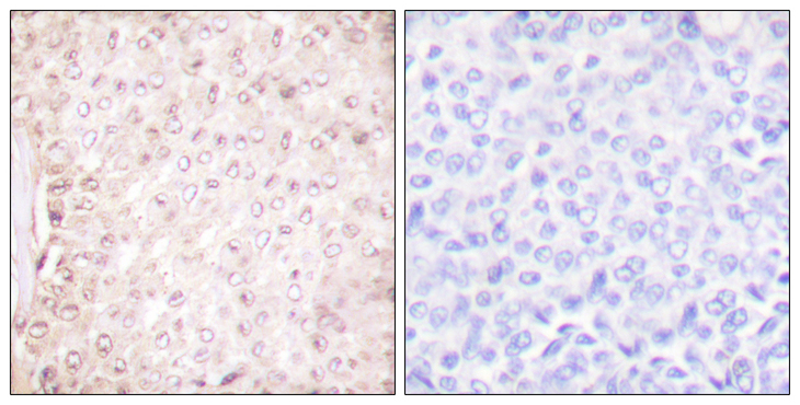 CSTB / Cystatin B / Stefin B Antibody - Immunohistochemistry analysis of paraffin-embedded human breast carcinoma tissue, using Stefin B Antibody. The picture on the right is blocked with the synthesized peptide.
