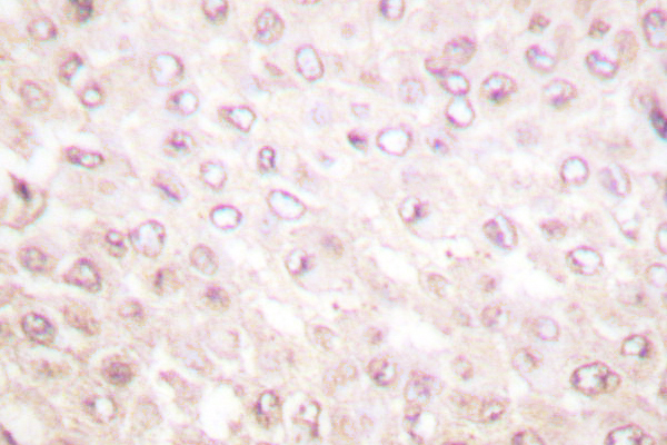 CSTB / Cystatin B / Stefin B Antibody - IHC of Stefin B (N84) pAb in paraffin-embedded human breast carcinoma tissue.