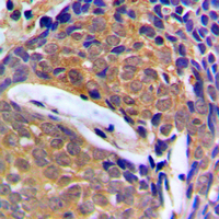 CSTB / Cystatin B / Stefin B Antibody - Immunohistochemical analysis of Cystatin B staining in human breast cancer formalin fixed paraffin embedded tissue section. The section was pre-treated using heat mediated antigen retrieval with sodium citrate buffer (pH 6.0). The section was then incubated with the antibody at room temperature and detected using an HRP conjugated compact polymer system. DAB was used as the chromogen. The section was then counterstained with hematoxylin and mounted with DPX.
