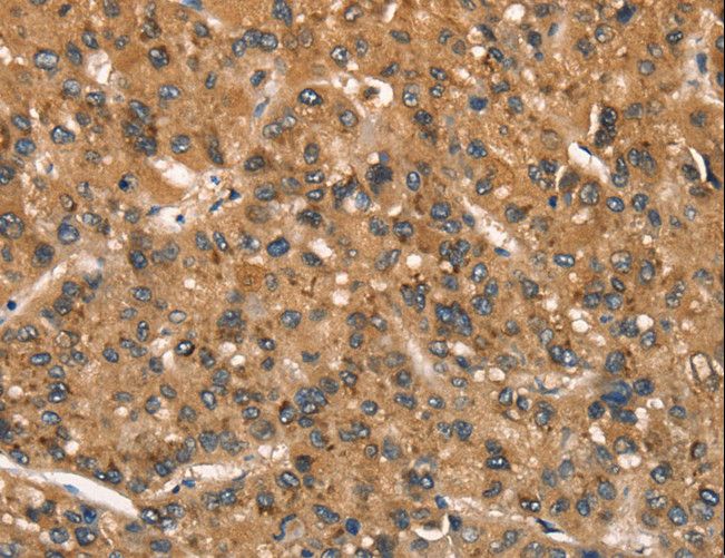 CSTB / Cystatin B / Stefin B Antibody - Immunohistochemistry of paraffin-embedded Human liver cancer using CSTB Polyclonal Antibody at dilution of 1:30.