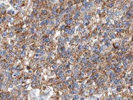 CSTB / Cystatin B / Stefin B Antibody - 1:100 staining human lung carcinoma tissue by IHC-P. The tissue was formaldehyde fixed and a heat mediated antigen retrieval step in citrate buffer was performed. The tissue was then blocked and incubated with the antibody for 1.5 hours at 22°C. An HRP conjugated goat anti-rabbit antibody was used as the secondary.