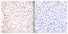 CSTB / Cystatin B / Stefin B Antibody - Peptide - + Immunohistochemical analysis of paraffin-embedded human breast carcinoma tissue using Stefin B antibody.