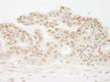 CSTF1 Antibody - Detection of Human CSTF50 by Immunohistochemistry. Sample: FFPE section of human ovarian carcinoma. Antibody: Affinity purified rabbit anti-CSTF50 used at a dilution of 1:250.