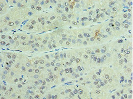CSTF2 / CstF-64 Antibody - Immunohistochemistry of paraffin-embedded human liver cancer using CSTF2 Antibody at dilution of 1:100