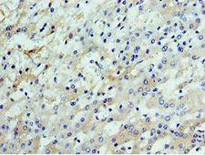 CSTF2 / CstF-64 Antibody - Immunohistochemistry of paraffin-embedded human liver cancer using antibody at 1:100 dilution.