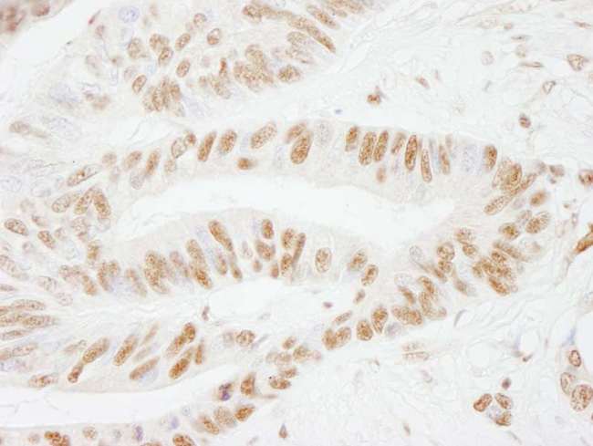 CSTF2 / CstF-64 Antibody - Detection of Human CSTF64 by Immunohistochemistry. Sample: FFPE section of human ovarian carcinoma. Antibody: Affinity purified rabbit anti-CSTF64 used at a dilution of 1:1000 (1 ug/ml). Detection: DAB.