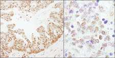 CSTF2 / CstF-64 Antibody - Detection of Human and Mouse CSTF64 by Immunohistochemistry. Sample: FFPE section of human ovarian carcinoma (left) and mouse teratoma (right). Antibody: Affinity purified rabbit anti-CSTF64 used at a dilution of 1:1000 (1 ug/ml). Detection: DAB.