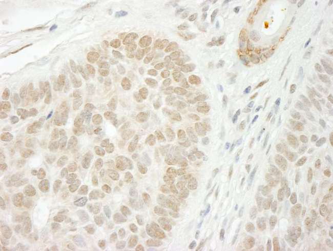 CSTF2T Antibody - Detection of Human CSTF2T/TauCSTF64 Immunohistochemistry. Sample: FFPE section of human skin squamous cell carcinoma. Antibody: Affinity purified rabbit anti-CSTF2T/TauCSTF64 used at a dilution of 1:250.