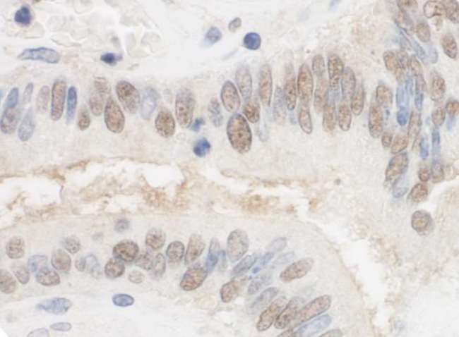 CSTF2T Antibody - Detection of Human CSTF2T/TauCSTF64 by Immunohistochemistry. Sample: FFPE section of human colon carcinoma. Antibody: Affinity purified rabbit anti-CSTF2T/TauCSTF64 used at a dilution of 1:1000 (1 ug/ml). Detection: DAB.