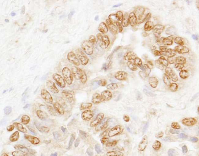 CSTF3 Antibody - Detection of Human CSTF77 by Immunohistochemistry. Sample: FFPE section of human prostate carcinoma. Antibody: Affinity purified rabbit anti-CSTF77 used at a dilution of 1:200 (1 ug/ml). Detection: DAB.