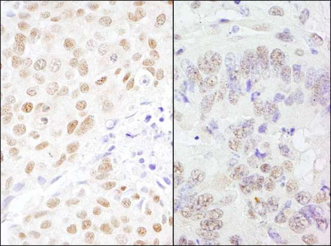 CSTF3 Antibody - Detection of Human and Mouse CSTF77 by Immunohistochemistry. Sample: FFPE section of human breast carcinoma (left) and mouse teratoma (right). Antibody: Affinity purified rabbit anti-CSTF77 used at a dilution of 1:200 (1 ug/ml). Detection: DAB.