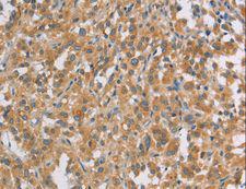 CT26 / DDX53 Antibody - Immunohistochemistry of paraffin-embedded Human thyroid cancer using DDX53 Polyclonal Antibody at dilution of 1:40.
