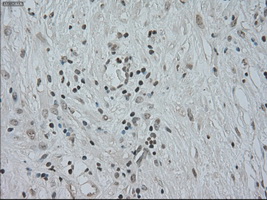 CTAG1B / NY-ESO-1 Antibody - IHC of paraffin-embedded Carcinoma of pancreas tissue using anti-CTAG1B mouse monoclonal antibody. (Dilution 1:50).