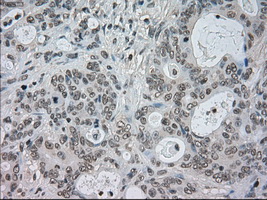 CTAG1B / NY-ESO-1 Antibody - IHC of paraffin-embedded Adenocarcinoma of colon tissue using anti-CTAG1B mouse monoclonal antibody. (Dilution 1:50).