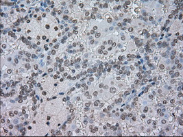 CTAG1B / NY-ESO-1 Antibody - IHC of paraffin-embedded Carcinoma of kidney tissue using anti-CTAG1B mouse monoclonal antibody. (Dilution 1:50).
