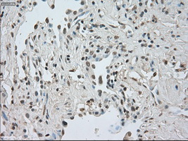 CTAG1B / NY-ESO-1 Antibody - IHC of paraffin-embedded Carcinoma of lung tissue using anti-CTAG1B mouse monoclonal antibody. (Dilution 1:50).