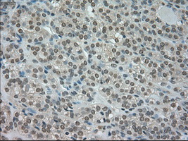 CTAG1B / NY-ESO-1 Antibody - IHC of paraffin-embedded Carcinoma of thyroid tissue using anti-CTAG1B mouse monoclonal antibody. (Dilution 1:50).