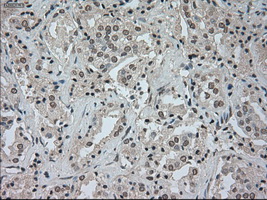 CTAG1B / NY-ESO-1 Antibody - IHC of paraffin-embedded Carcinoma of prostate tissue using anti-CTAG1B mouse monoclonal antibody. (Dilution 1:50).