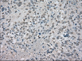 CTAG1B / NY-ESO-1 Antibody - IHC of paraffin-embedded Carcinoma of bladder tissue using anti-CTAG1B mouse monoclonal antibody. (Dilution 1:50).