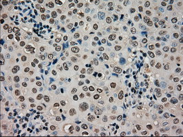 CTAG1B / NY-ESO-1 Antibody - IHC of paraffin-embedded Adenocarcinoma of breast tissue using anti-CTAG1B mouse monoclonal antibody. (Dilution 1:50).