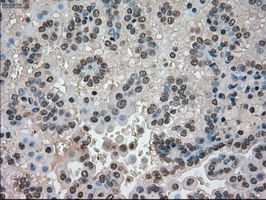 CTAG1B / NY-ESO-1 Antibody - IHC of paraffin-embedded Carcinoma of kidney tissue using anti-CTAG1B mouse monoclonal antibody. (Dilution 1:50).